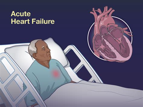 Heart failure is a disqualifying medical condition for military service