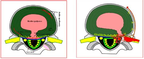 A diagram of a hernia