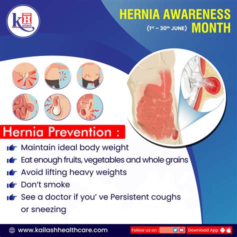 Hernia Prevention