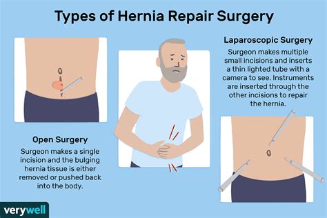 A diagram of hernia surgery