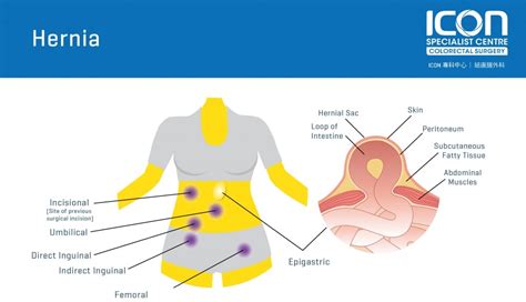 A diagram of hernia symptoms