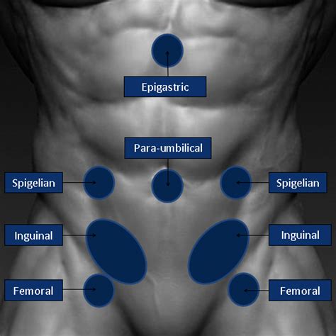 Types of Hernias