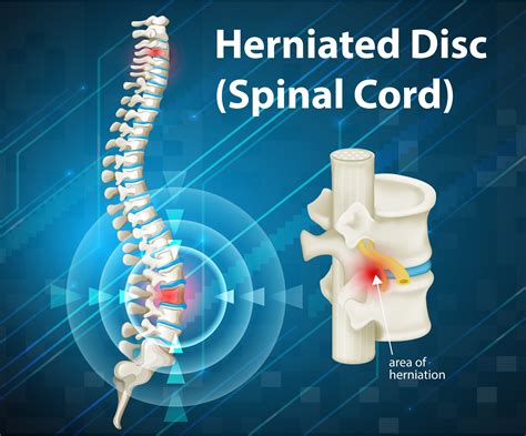 Herniated discs diagram