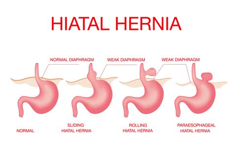 Hiatal Hernia