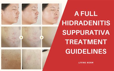 Description of Hidradenitis Prevention