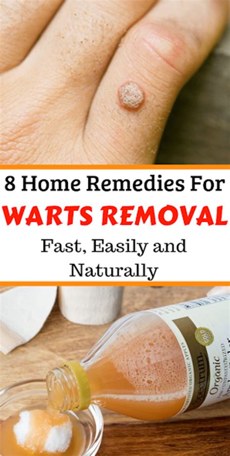 Home Remedies for Wart Removal