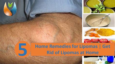 Description of Homeopathic Remedies for Lipoma