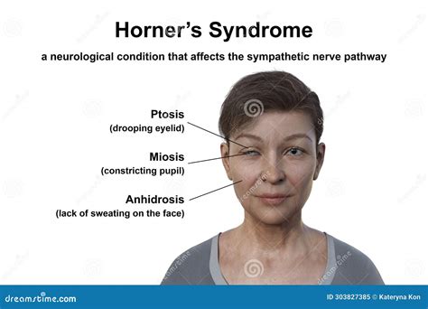 Horner Syndrome in Dogs