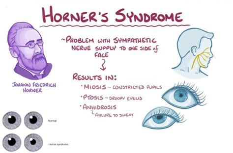 Horner's Syndrome Management