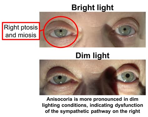 Horner's Syndrome Prognosis