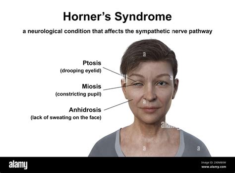 Symptoms of Horner's Syndrome in Dogs