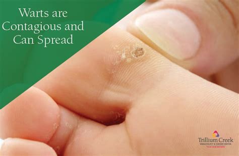 How are Warts Spread