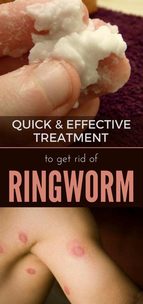 How bleach works to treat ringworm