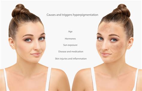 Understanding Hyperpigmentation