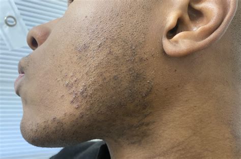 Hyperpigmentation skin condition