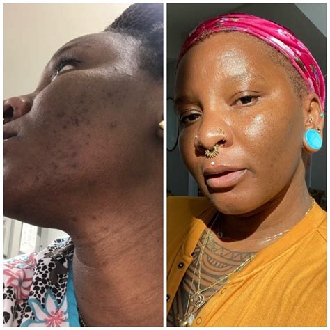 Hyperpigmentation Before and After