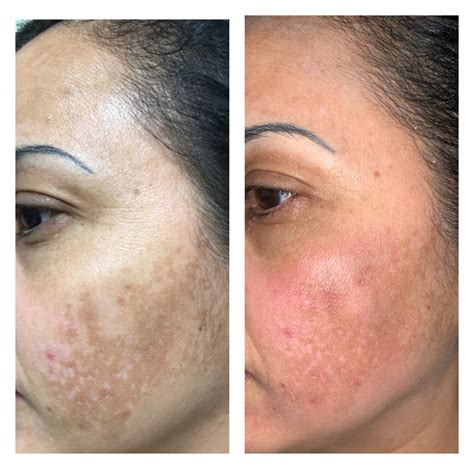 Hyperpigmentation Treatment