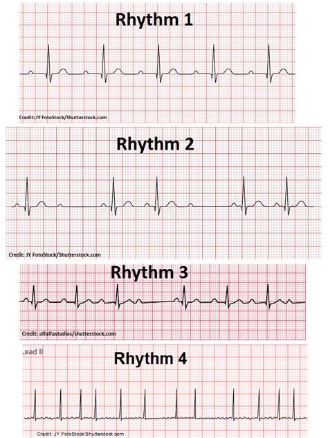 Identify EKG rhythm