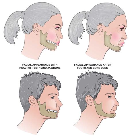 Impact of Jaw Shaped Features on Beauty