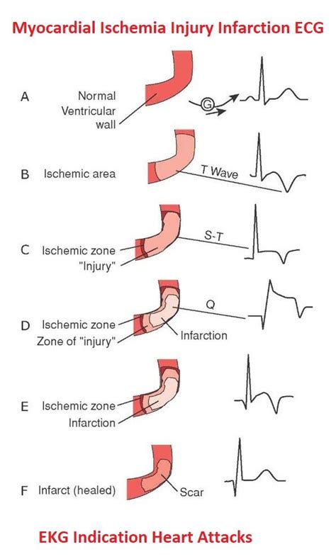 Infarction EKG interpretation