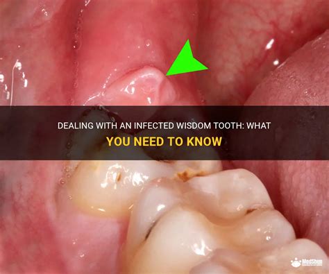 Infected Wisdom Tooth