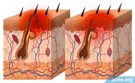 Ingrown hairs