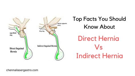 Inguinal Hernia