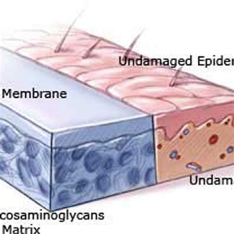 Integra Dermal Regeneration Template Application