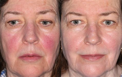 IPL Treatment for Ocular Rosacea