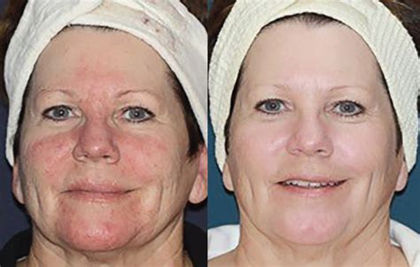 IPL Treatment for Rosacea