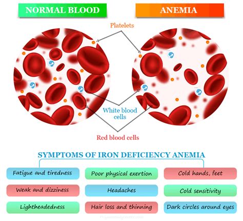 Iron Deficiency Anemia