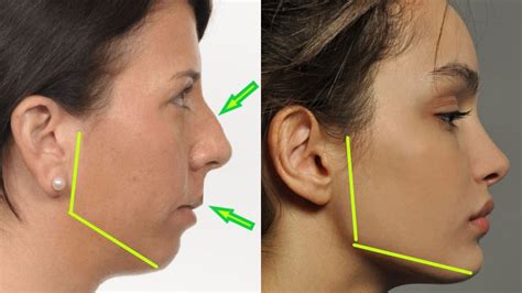 Jaw Shaped Features and Facial Aesthetics