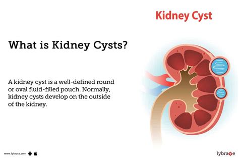 Kidney Cyst Symptoms