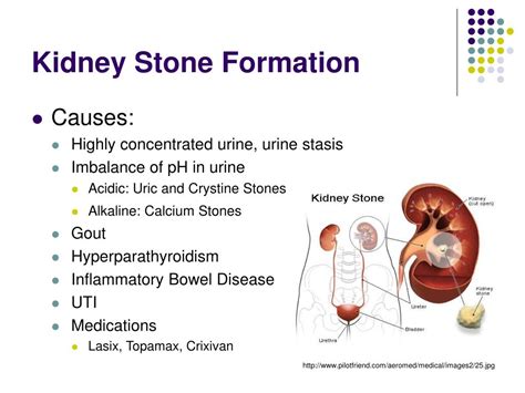 Kidney Stone Formation