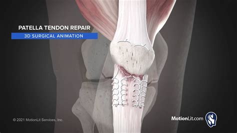 Knee Tendon Surgery