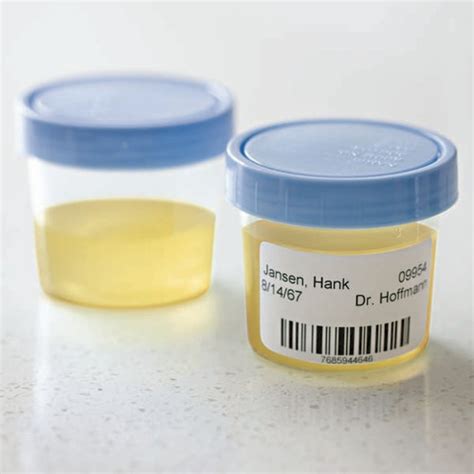 Labeling Urine Specimen