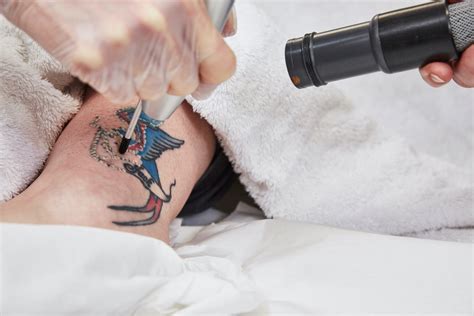 Laser tattoo removal clinic