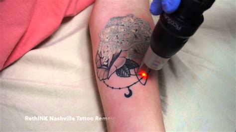 Laser tattoo removal in Nashville