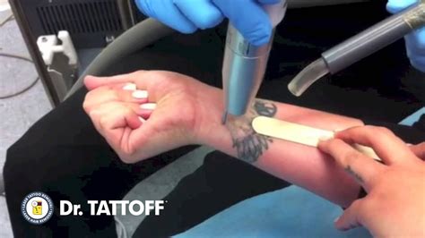 Laser tattoo removal Phoenix