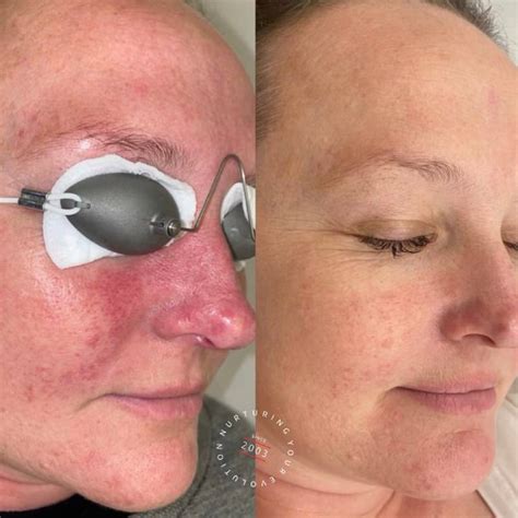 Laser Treatment for Ocular Rosacea