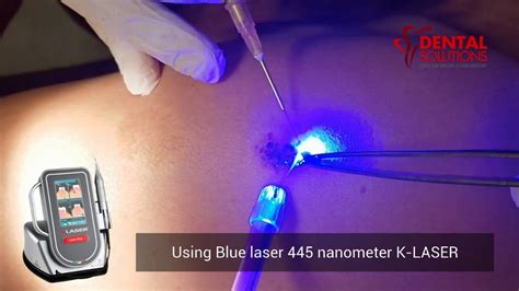 Laser Treatment for Wart Removal