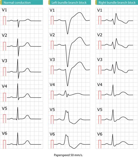 Left Bundle Branch Block EKG