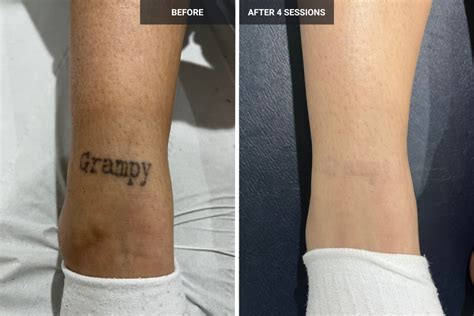 Leg tattoo removal and cover-up options