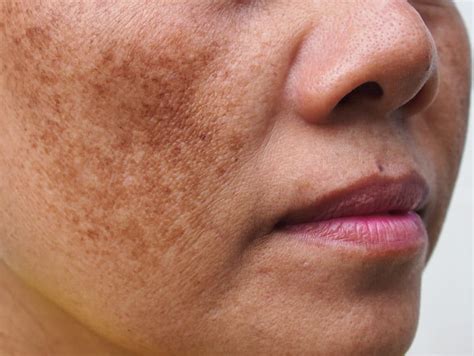 Lifestyle Changes for Hyperpigmentation