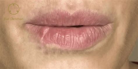 Lip scars can be caused by various factors