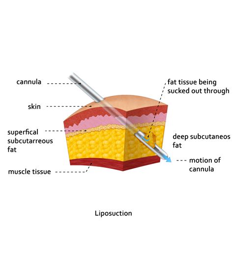 Lipo Procedure Techniques