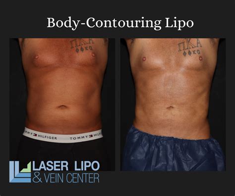 Lipo Transformation Before and After