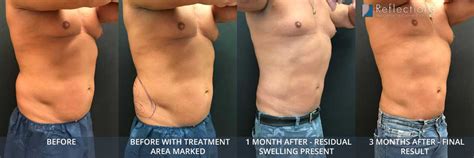 Lipo Transformation Risks