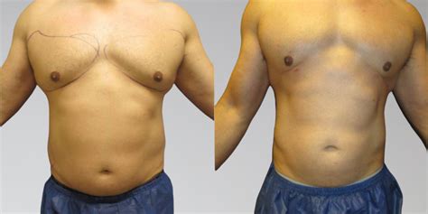 Lipo Transformation Success Rates