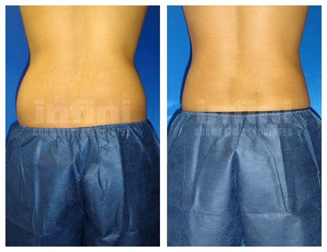 Lipo Waist Contouring Procedure